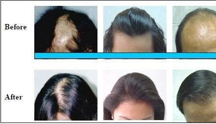 Homeopathic Treatment For Hair Disease