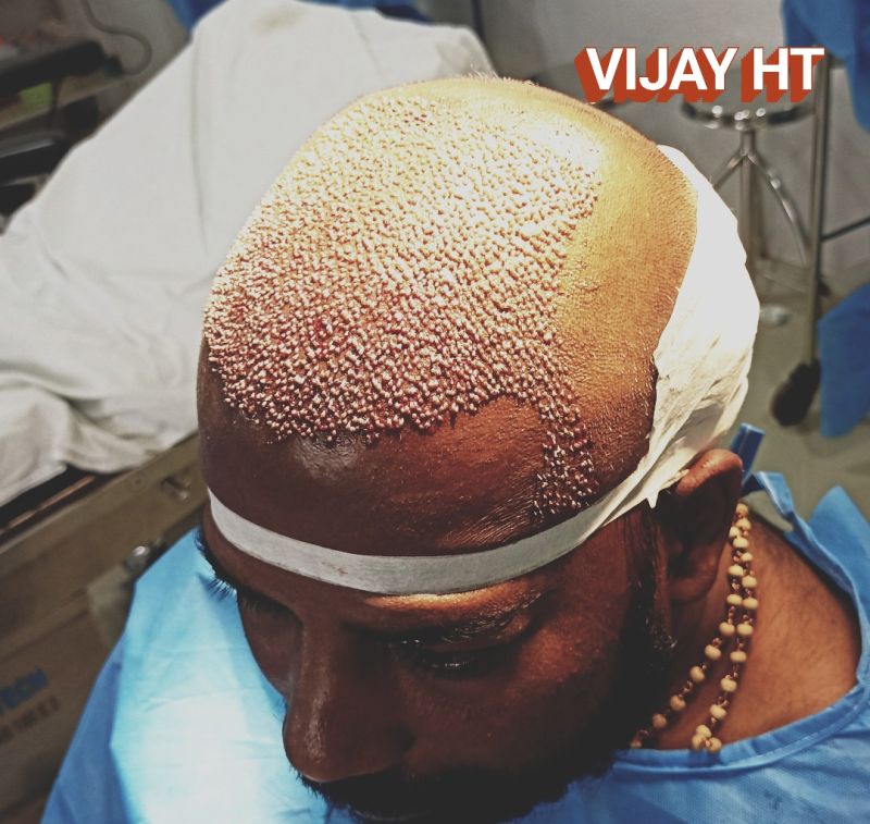 Vijay Kumar - Hair transplant specialist - Self Employed | LinkedIn