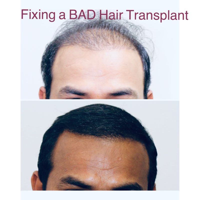 Dr Sreedhar Reddy pothula - Director - pioneer advanced hair transplant  centre | LinkedIn