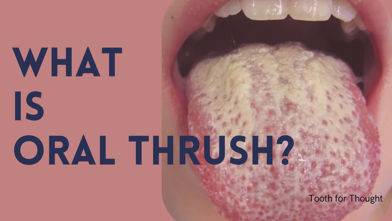What is Oral Thrush?