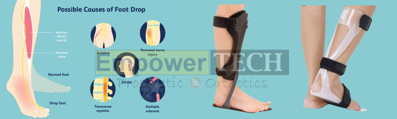 Understanding Foot Drop: The Effectiveness of Orthotics in Foot Drop  Treatment.