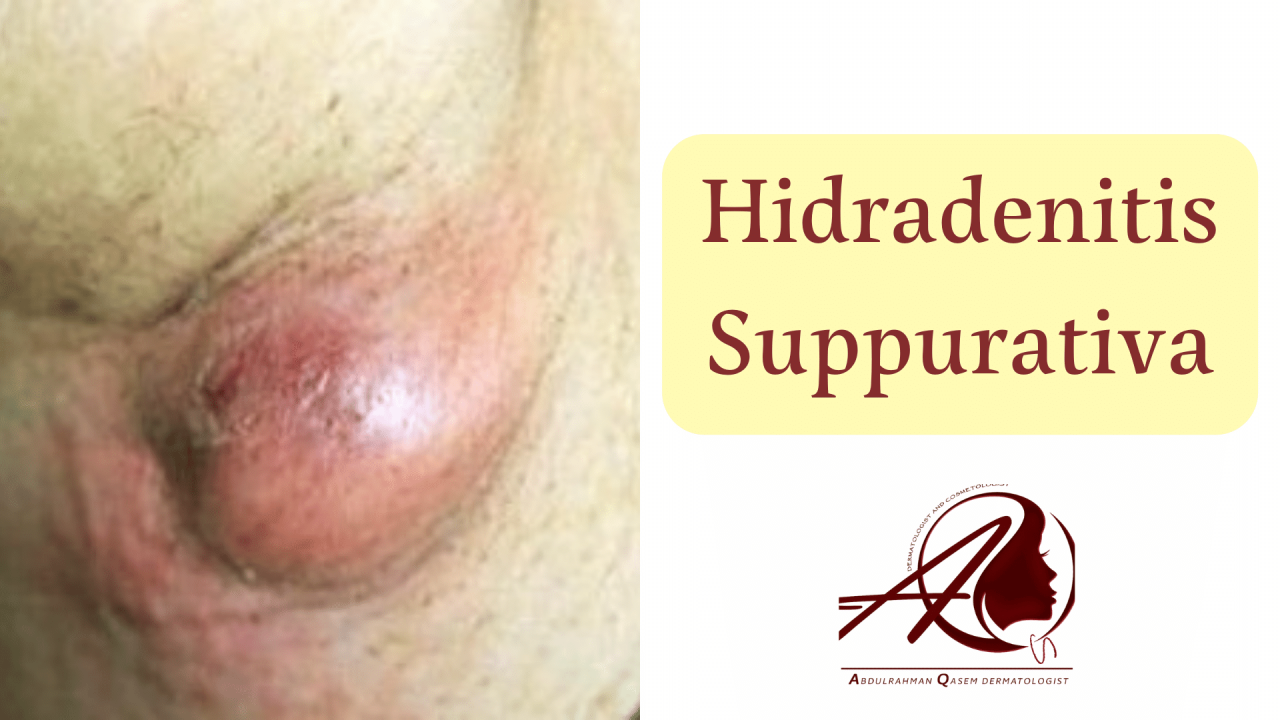 Hidradenitis Suppurativa: Understanding Causes, Symptoms, and Effective Treatments
