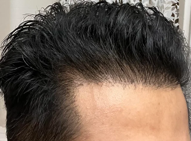 Hair Transplant Cost in Dubai UAE ?