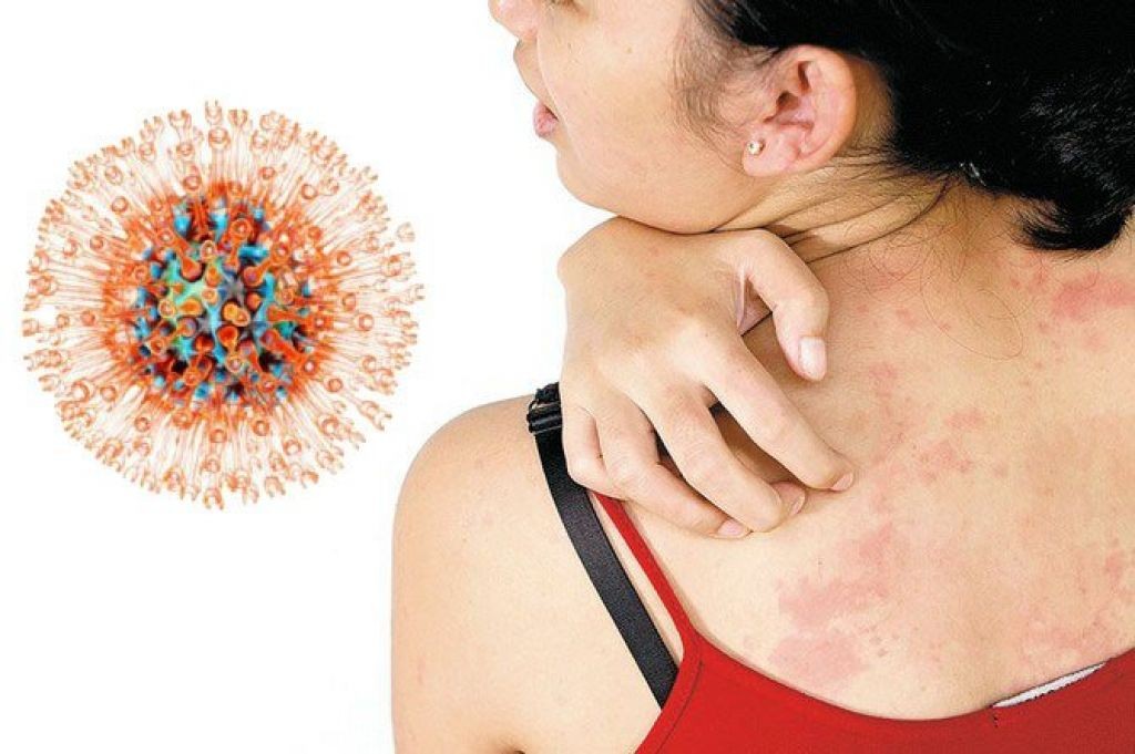 Herpes Zoster Market Applications, Outstanding Growth, Market status and Business Opportunities 2030