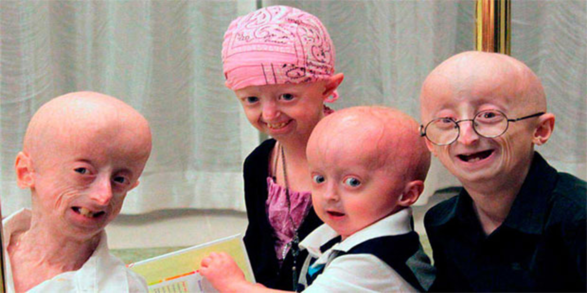 FDA approves the first drug for Hutchinson-Gilford Progeria Syndrome (HGPS)