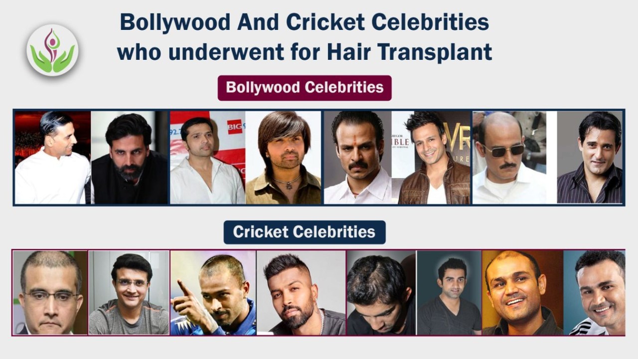 Bollywood And Cricket Celebrities who underwent Hair Transplant
