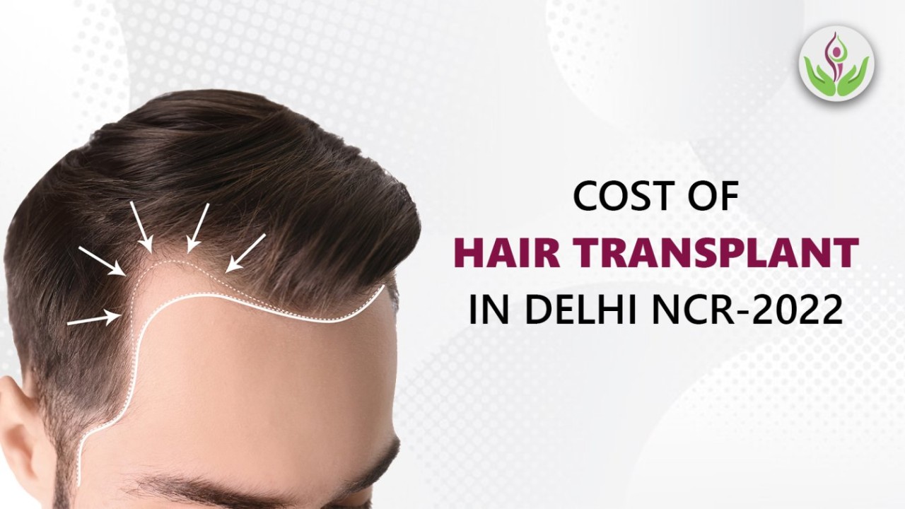 The Cost of Hair Transplant In Delhi NCR 2022 Might Surprise You