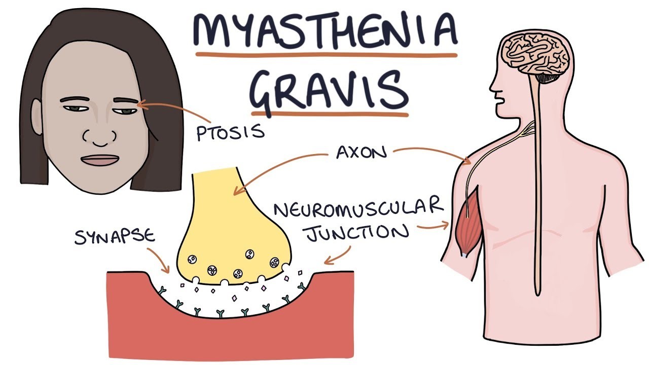 Advancements and Challenges in the Myasthenia Gravis Treatment Market