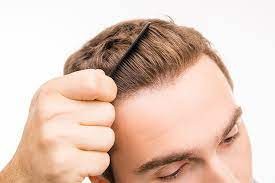 Other Nonsurgical Options : The Best Hair Specialist Doctor ?