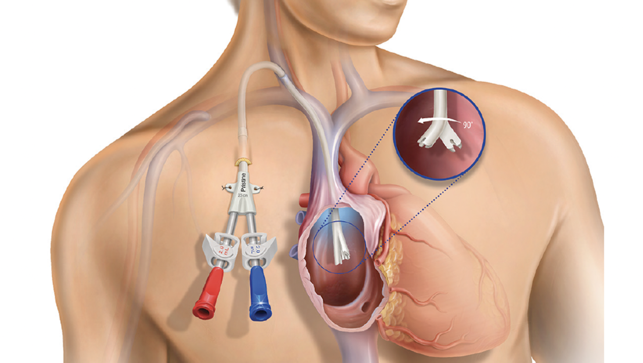 Hemodialysis Catheters Market to Hit USD 1,214 million By 2030