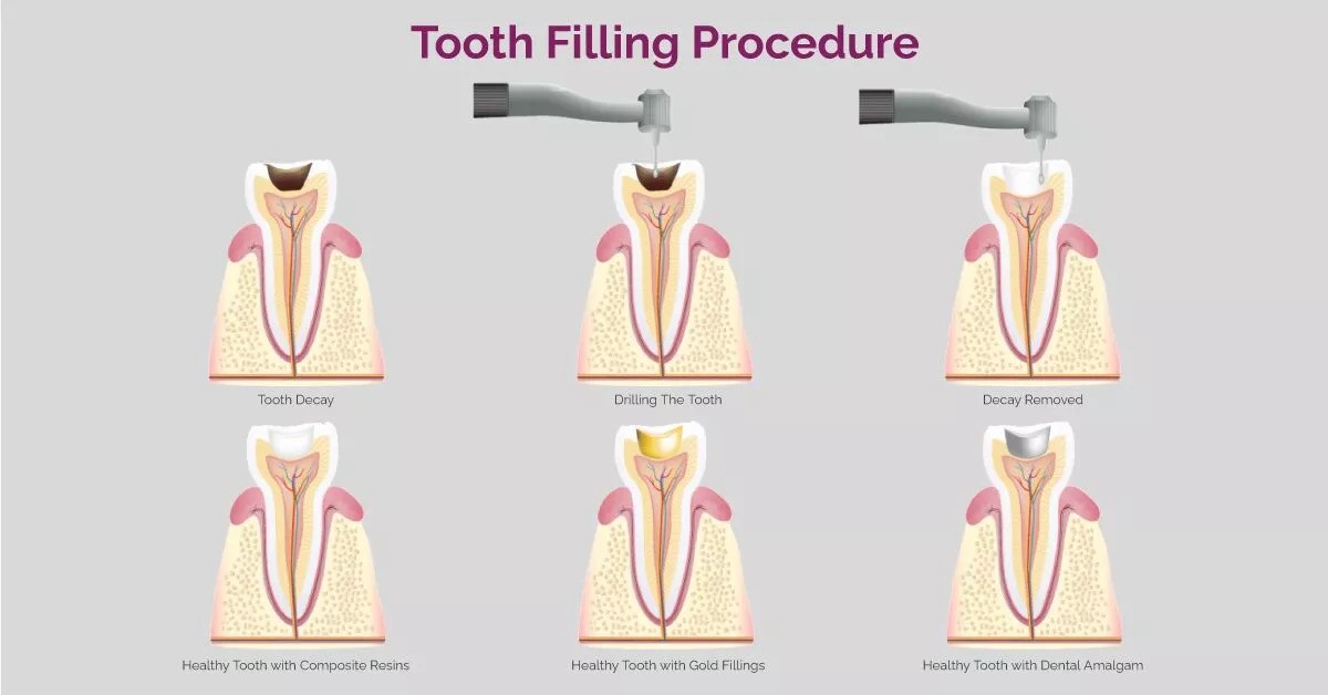 What Is a Tooth Filling and Its Procedure