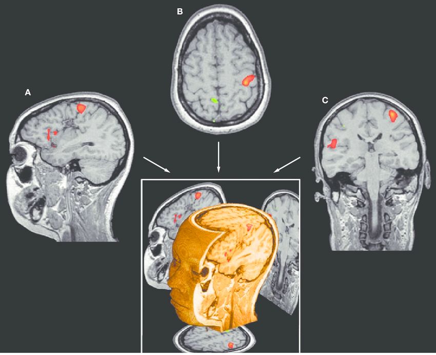 Arbi Ayari on LinkedIn: 🔍 **Understanding fMRI: Mapping Brain Activity ...