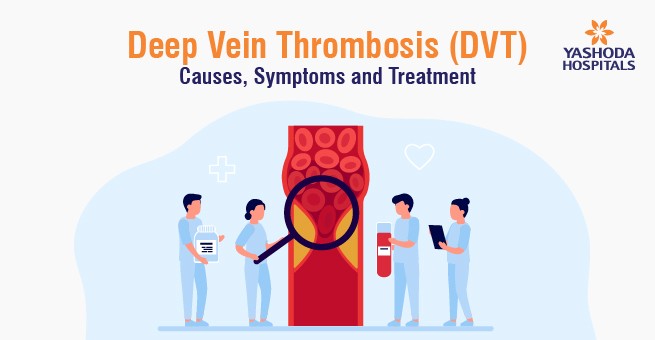 Deep Vein Thrombosis (DVT): What is it and how is it treated?