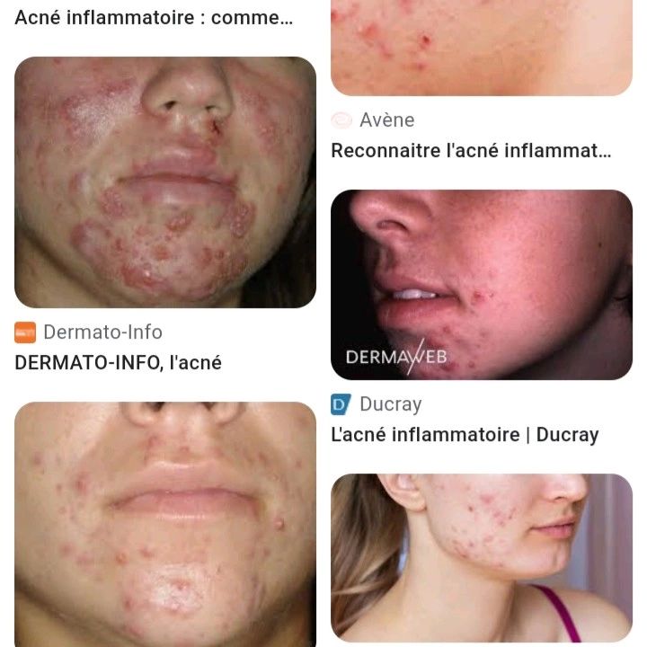 Dr Gora Thioune sur LinkedIn : L'acné, définitions, facteurs ...