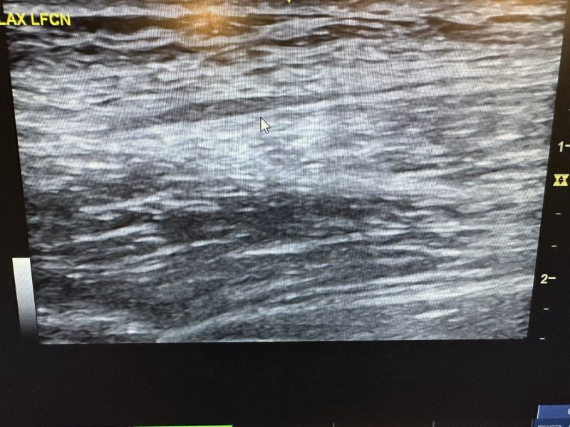 Charles Stevens DPT RMSK COMT CLT AIB VAM on LinkedIn: Patient Charles Stevens DPT RMSK COMT CLT AIB VAM on LinkedIn: Patient