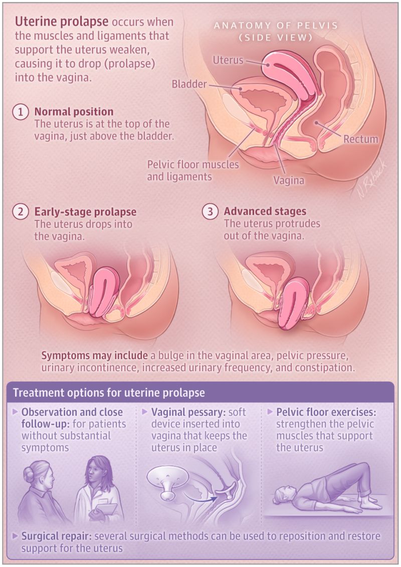 JAMA on LinkedIn: Uterine prolapse occurs when the uterus drops