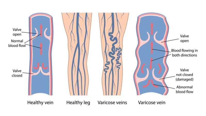 Varicocele Healing Ltd. on LinkedIn: 10 Key Points About Varicocele  Underwear! Why Natural Treatment for…