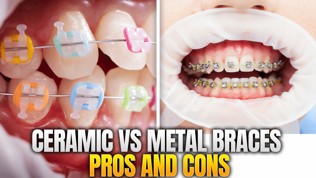 Metal vs Plastic vs Ceramic Brackets