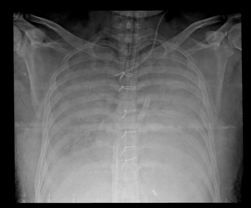 Harlequin syndrome – a clinical experience in VA ECMO