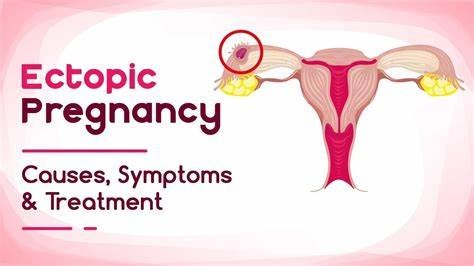 Abdominal Ectopic Pregnancy.