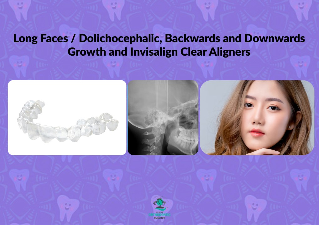 Long, Dolichocephalic Faces with Backwards and Downwards Growth and Invisalign or Clear Aligners