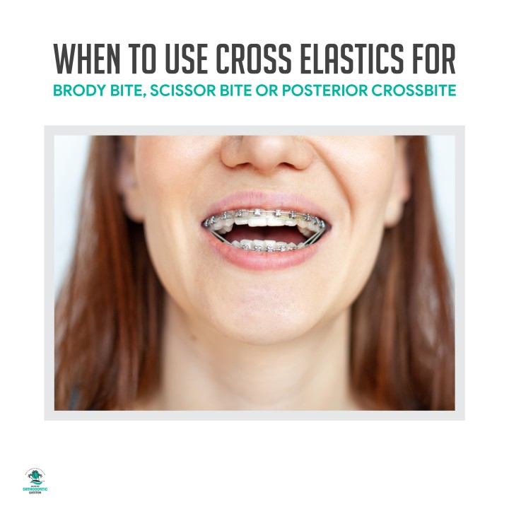 When to Use Cross Elastics- Brody, Scissor, and Posterior Crossbite