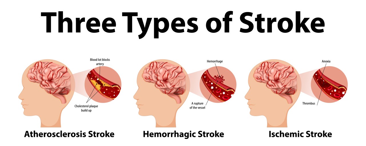 Recognizing the Gendered Signs of Impending Stroke and How to Provide Assistance