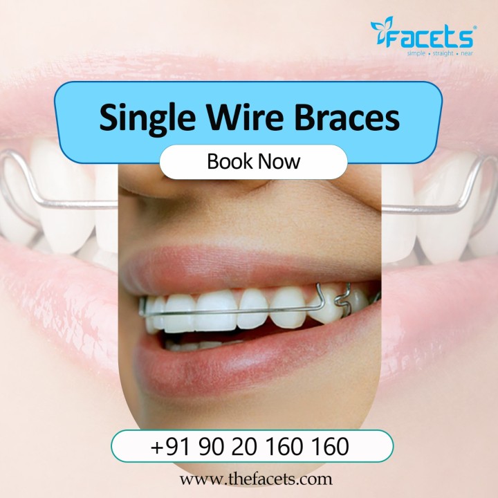 The Brilliance of Single Wire Braces: Straightening Smiles with Style! 😁