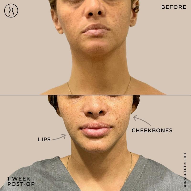 AirSculpt on LinkedIn: Achieving Fuller Lips: The Ultimate Guide to Lip  Augmentation
