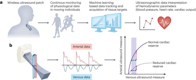 Muyang Lin on LinkedIn: Wearable ultrasound for continuous deep