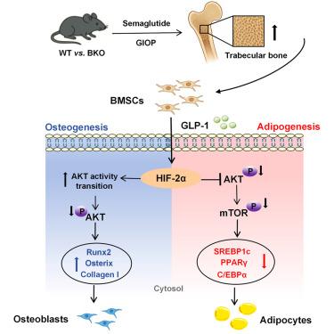 glp-1 osteoporosis Use Associated with Lower Risk in Adults with Type 2 Diabetes but Higher Risk in Adults Without Diabetes GLP-1 drugs like Ozempic can