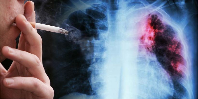 tuberculosis cigarette smoking Joint research tackles and TB, a 'colliding epidemic' TUBERCULOSIS: Mark and Prevent Yourself