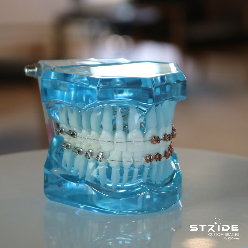 klowen brackets Advances in Custom Braces Technology Customized Braces Kissimmee-3 Easy Ways