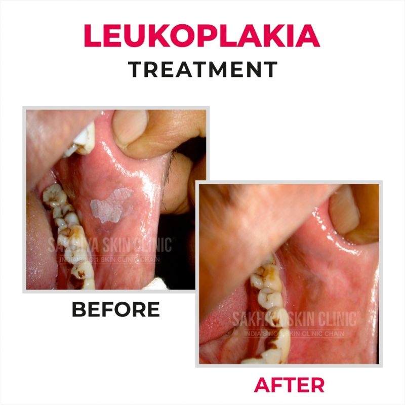leukoplakia after quitting tobacco Management of oral in young smokers Leukoplakia: Symptoms, causes, and prevention