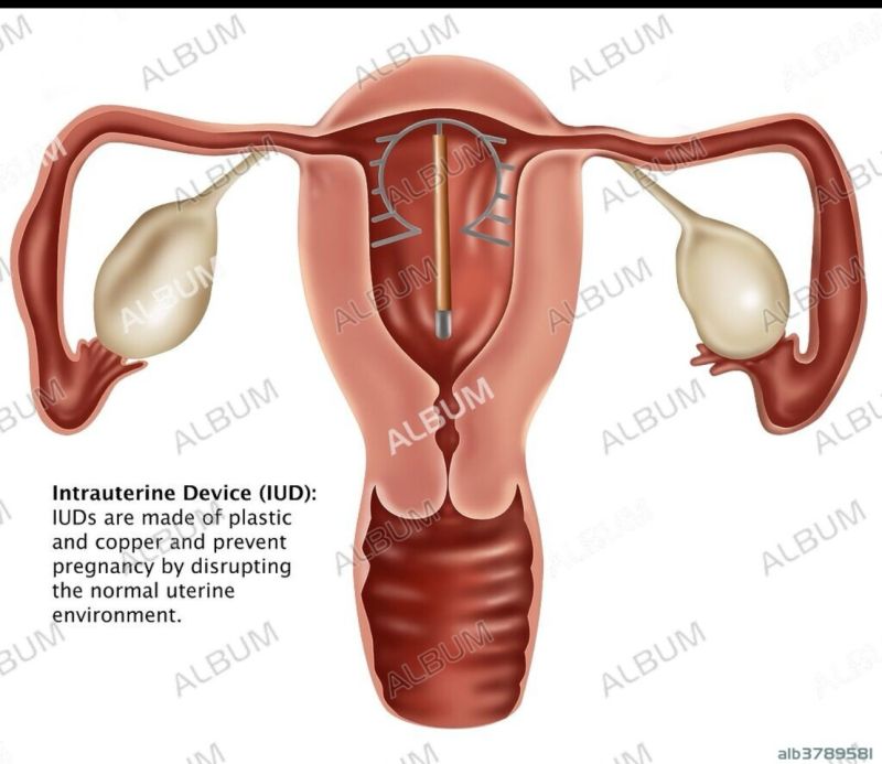 glp 1 and iud GLP-1 weight-loss drugs pose hidden risks for young women