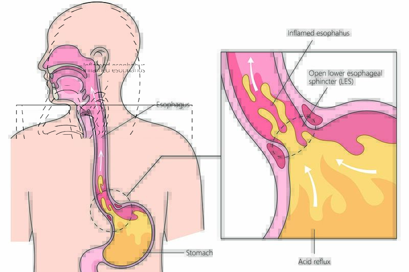 bpc-157 acid reflux Esophagogastric anastomosis in rats: Improved healing by BPC 157 and L-arginine, aggravated by L-NAME Does BPC-157 Help with Erectile