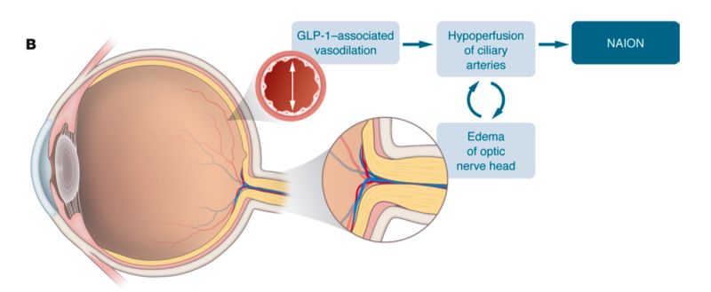 glp-1 and naion Agonists Linked to Rare Eye Condition | Dr. Sandeep Tak posted on the topic Australian regulator warns of 'rare