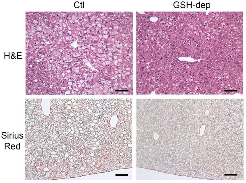 glutathione on liver A Literature Review of Therapy in Ameliorating Hepatic Dysfunction in Non-Alcoholic Fatty Disease Glutathione in liver diseases and