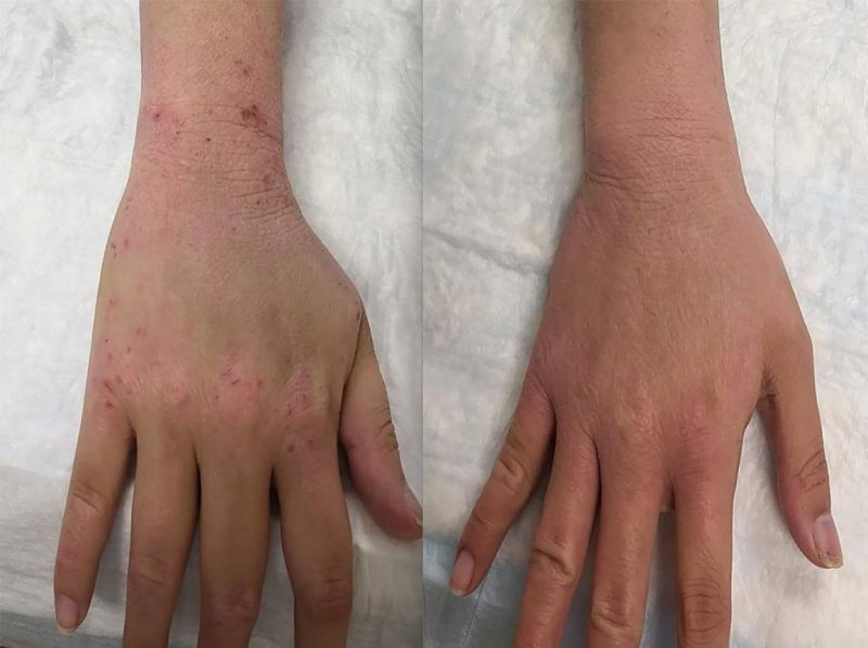 bpc 157 for eczema Liposomal BPC-157, Quicksilver Scientific Professional Supplement Center NIH finds new cause and