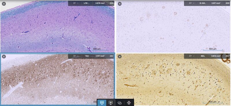 glp 1 alzheimer's disease Truth or Myth: GLP-1 medications are good for Incretin and insulin signaling as