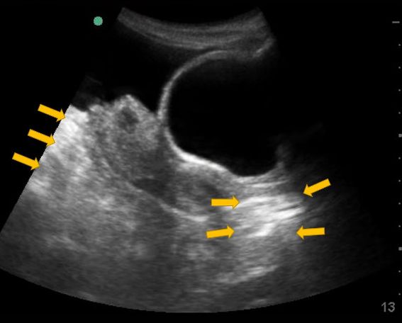 Point of Care Ultrasound Certification Academy on LinkedIn: An 18 year Point of Care Ultrasound Certification Academy on LinkedIn: An 18 year