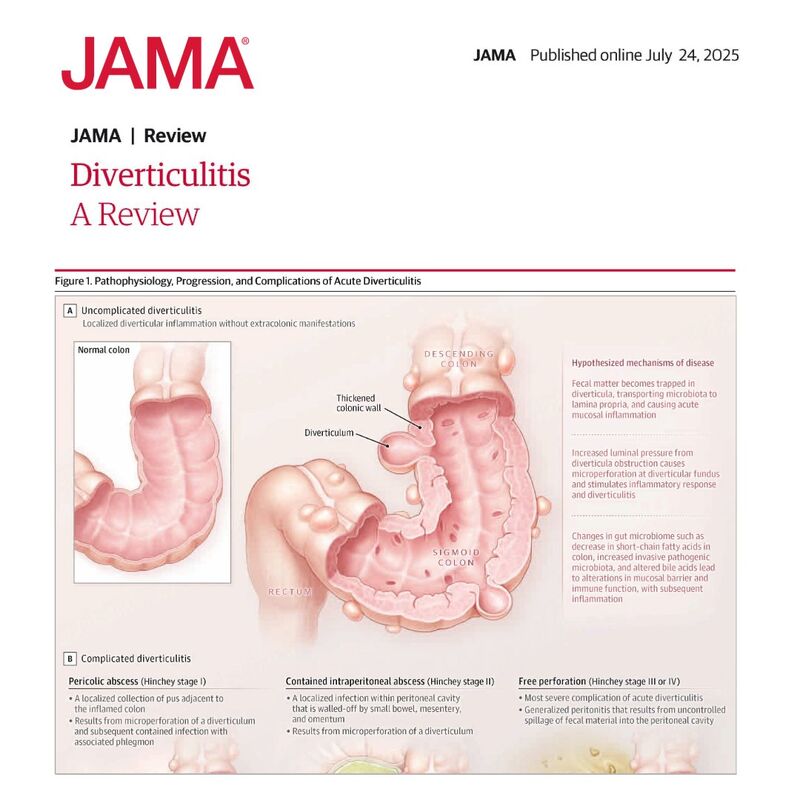 semaglutide and diverticulosis With Diverticulitis: Safety Key Cautions Understanding Diverticulitis: Pathogenesis, Diagnosis, and