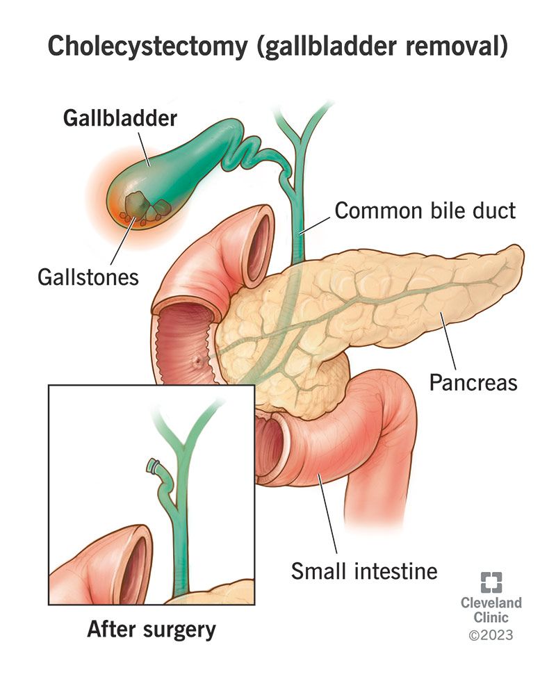 can you take semaglutide after gallbladder removal New Weight Loss Medications and Gallstones: What Need to Know Gallbladder Removal Surgery and Post-Surgical