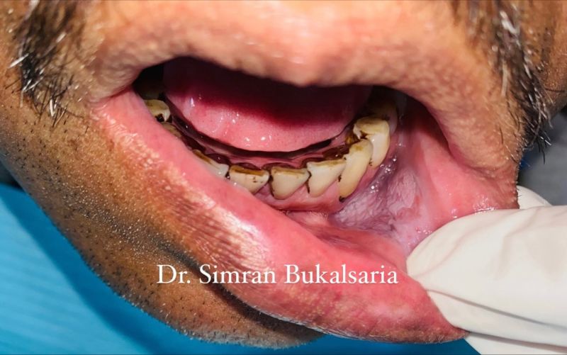 tobacco pouch keratosis appearance Pathology Spotlight: (Snuff Dipper's Lesion) This post breaks down a common mucosal lesion associated with smokeless tobacco use. Etiology & Risk: COM June 2006 Diagnosis -