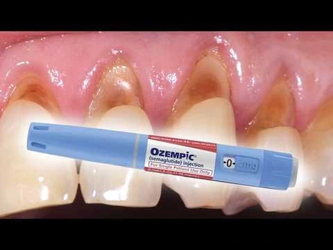 glp 1 and tooth decay Ozempic Teeth: Protect Your Smile on GLP-1 Ozempic Teeth: How GLP-1 Medications