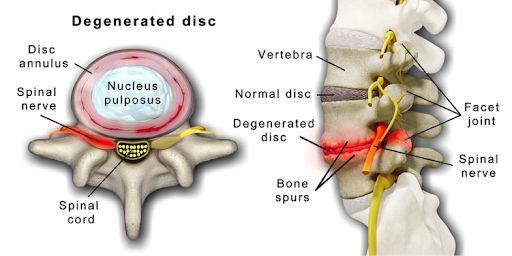joint pain on tirzepatide Side Effects and Muscle Can Tirzepatide Cause Joint Pain?